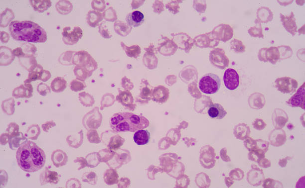istock Blood smear from Patients with anemia 512059790