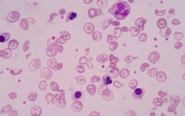 istock Blood smear from Patients with anemia 512059906