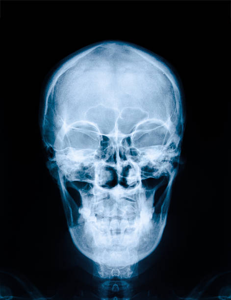 istock X-ray picture of skull 512418459