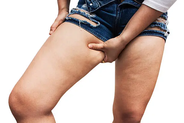 Fat thighs, cellulite of a teenage girl.