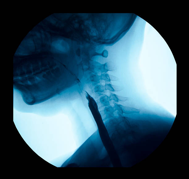 das bild von x-ray obermaterial gastrointestinal ugi, esophagram. - barium stock-fotos und bilder