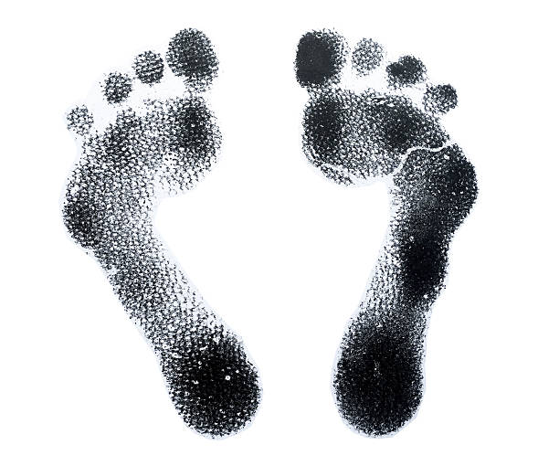 istock Foot print for sewing shoes diabetic , diabetic neuropathy 512912054