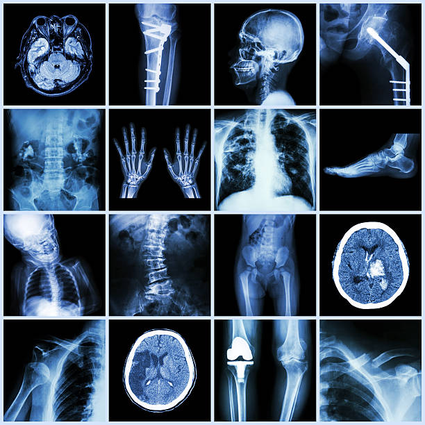 x-ray vários parte do homem, várias doenças, cirurgia ortopédica - cat scan pelvis hip human spine - fotografias e filmes do acervo