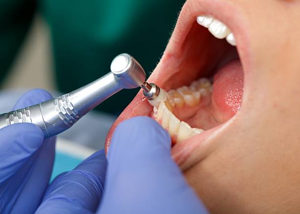 Professional dental brushing Close up of a professional dental brushing at the clinic human teeth stock pictures, royalty-free photos & images