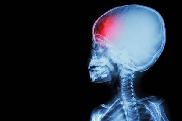 film x-ray body of child and headache( brain disease ) - neurology child stockfoto's en -beelden