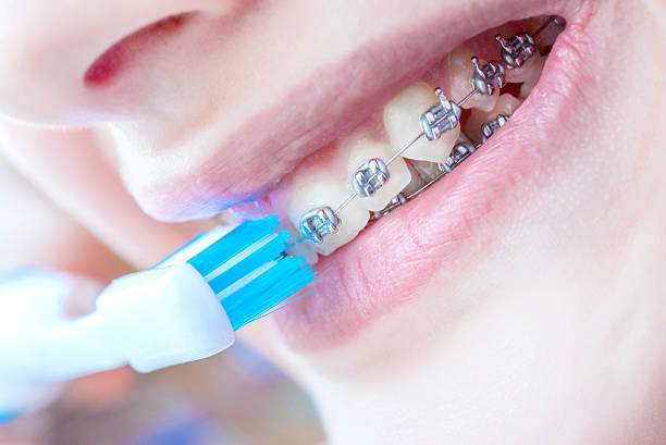 istock Close up female teeth with braces . 513049302