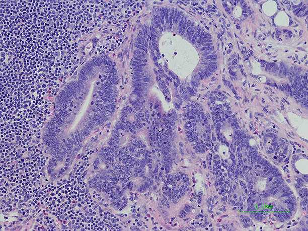 Lymph node with metastatic colonic adenocarcinoma H&E Stain Microscopic photograph of a professionally prepared slide demonstrating lymph node with metastatic colonic adenocarcinoma. H&E stain. lymph node photos stock pictures, royalty-free photos & images