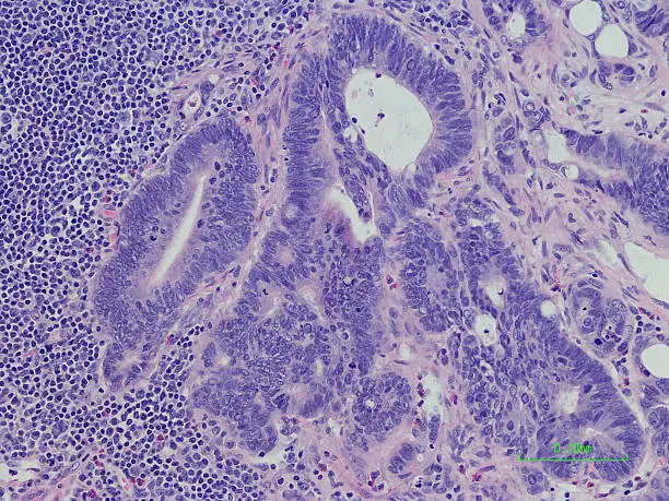 Photo of Lymph node with metastatic colonic adenocarcinoma H&E Stain