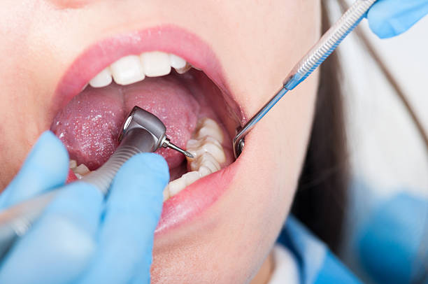 istock Close-up of dental drill use for patient teeth 513380764