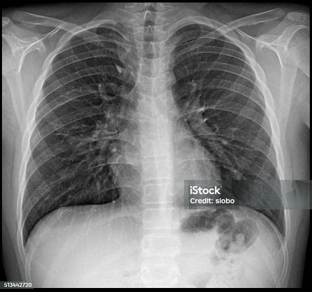 Gambar Rontgen Rontgen Dada Foto Stok - Unduh Gambar Sekarang - Gambar x-ray - Teknik ...