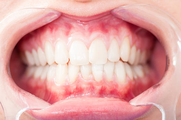 Close up of woman cavity protected by retractor showing perfect teeth