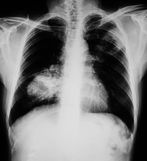 肺ガン x 線画像 - pain rib cage x ray image chest ストックフォトと画像