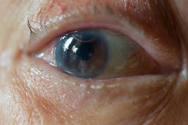 Old man's eye after cornea surgical operation and air bubble stock photo