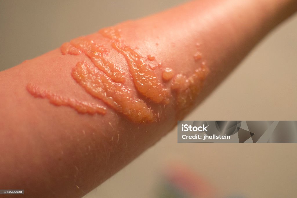 Blistered skin from jellyfish sting Allergy Stock Photo