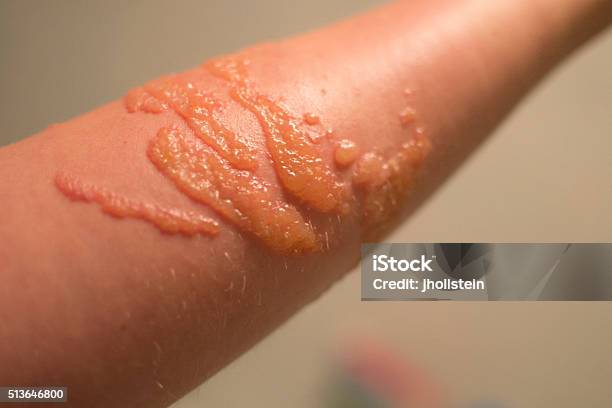 Blistered Skin From Jellyfish Sting Stock Photo - Download Image Now - Allergy, Blister, Horizontal