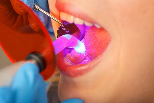 obturation dental - vinculación fotografías e imágenes de stock