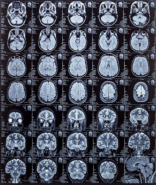 exames imagiológicos de ressonância magnética - brain mri scan alzheimers disease medical scan imagens e fotografias de stock