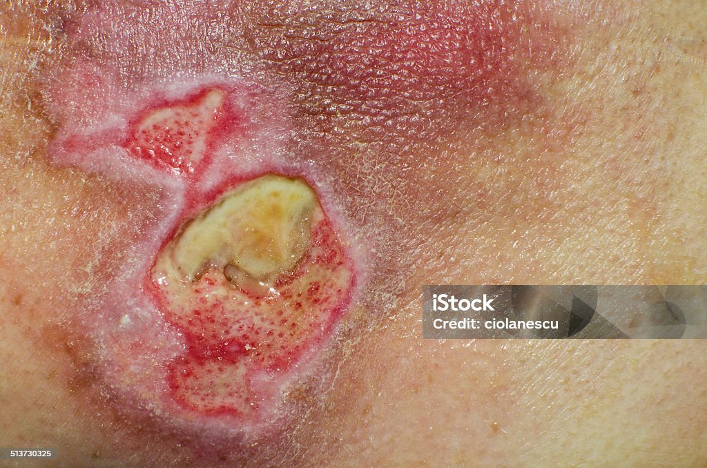 Serious open wound on a skin of an old man Wound Stock Photo
