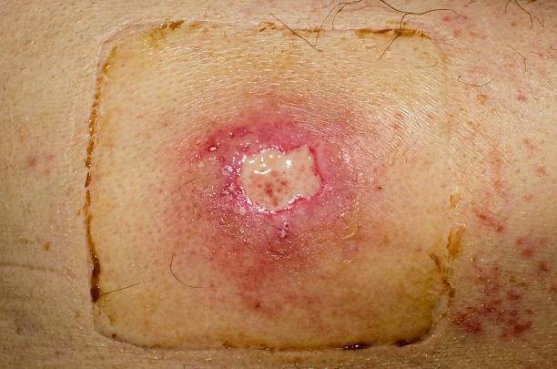 Arm wound on senior man prepped for stitching near Kuranda in Tropical north Queensland, Australia