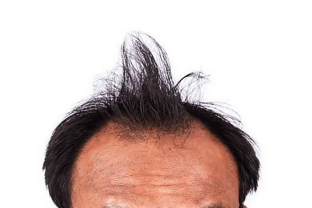 istock bald head of young man on white background 513886384