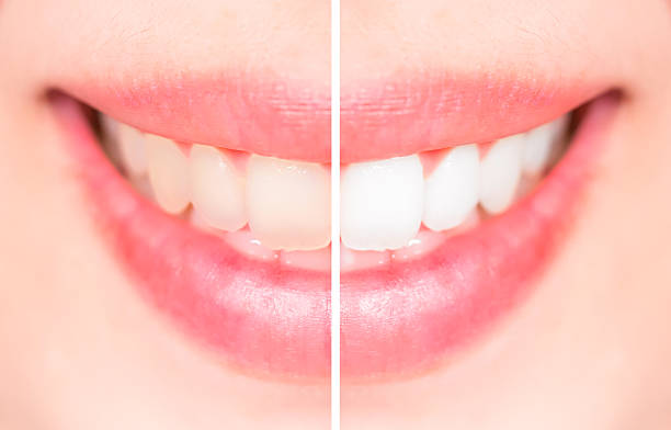 istock Close-up teeth female between before and after brush the teeth, 513889442