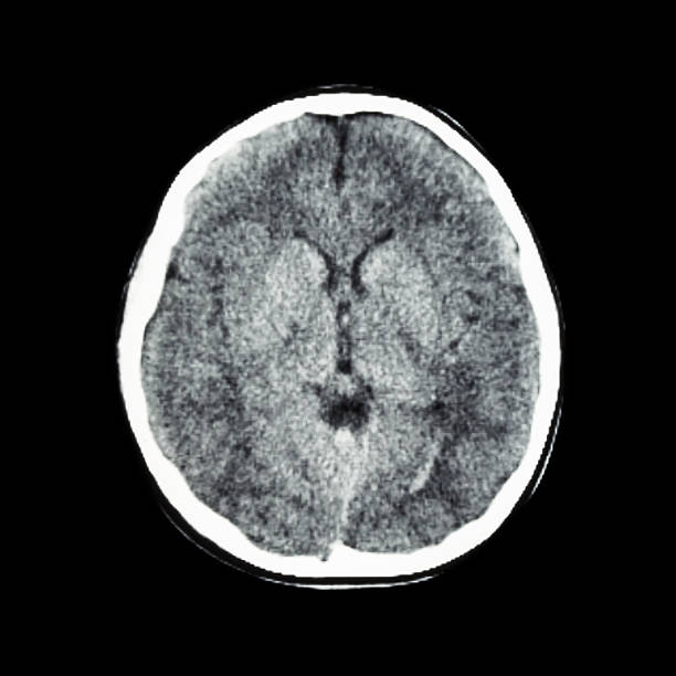 normalne tk mózgu (tomografia komputerowa) - human nervous system cat scan brain doctor zdjęcia i obrazy z banku zdjęć