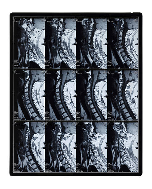 istock MRI Scan of Lumbar Spine 513942712