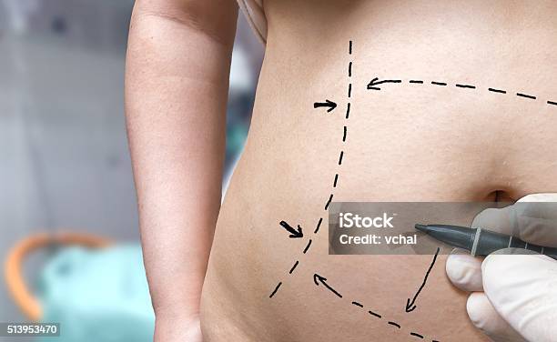Plastic Surgery Concept Hand Is Drawing With Marker On Belly Stock Photo - Download Image Now