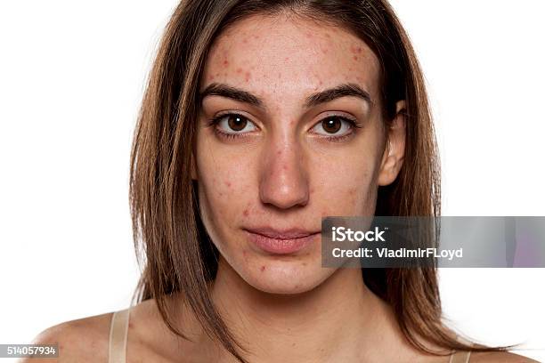 お肌の問題 - にきびのストックフォトや画像を多数ご用意 - にきび, 人の顔, 吹き出物