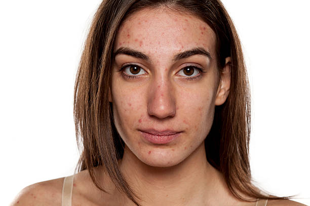 problematic skin stock photo