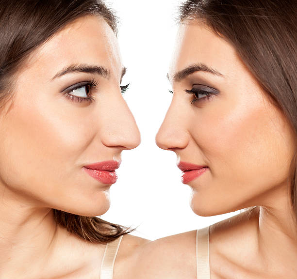 rhinoplasty comparative portrait of a beautiful young woman, before and after rhinoplasty human nose stock pictures, royalty-free photos & images