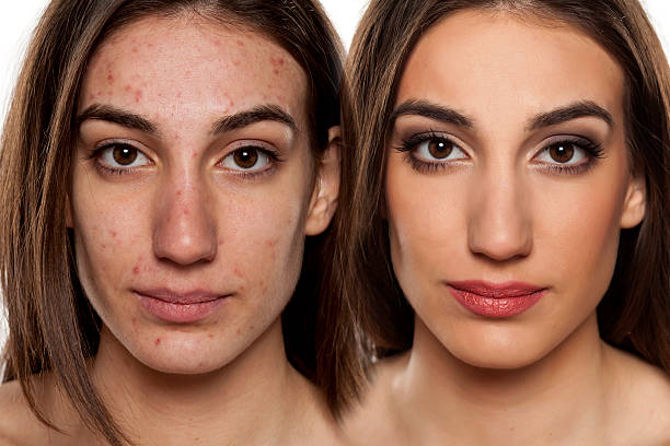 problematic skin before and after makeup Comparison portrait of a woman with problematic skin without and with makeup stage make up photos stock pictures, royalty-free photos & images