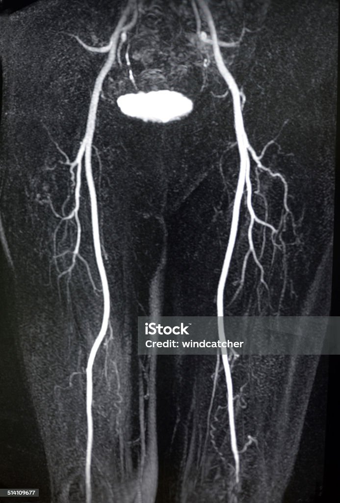 lower limbs artery MRA MRI image (MRA) show lower limbs artery. Femoral Artery Stock Photo
