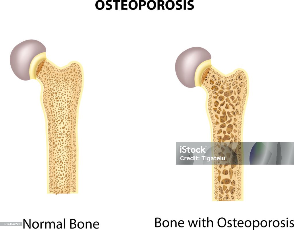 Cartoon Illustration Of Bone Of Hip Normal Bone And Bone With Osteoporosis  Stock Illustration - Download Image Now - iStock