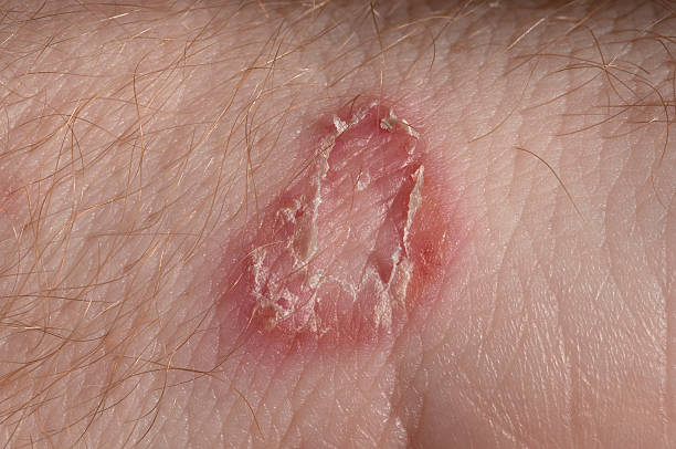 Ringworm on white man / Mycosis Ringworm on white man skin / Fungus Infection / Mycosis ringworm photos stock pictures, royalty-free photos & images