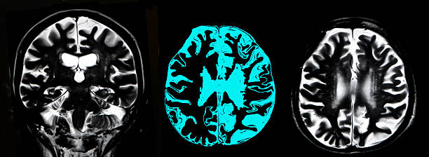 cervello atrofia, mri - mri scan human nervous system brain medical scan foto e immagini stock