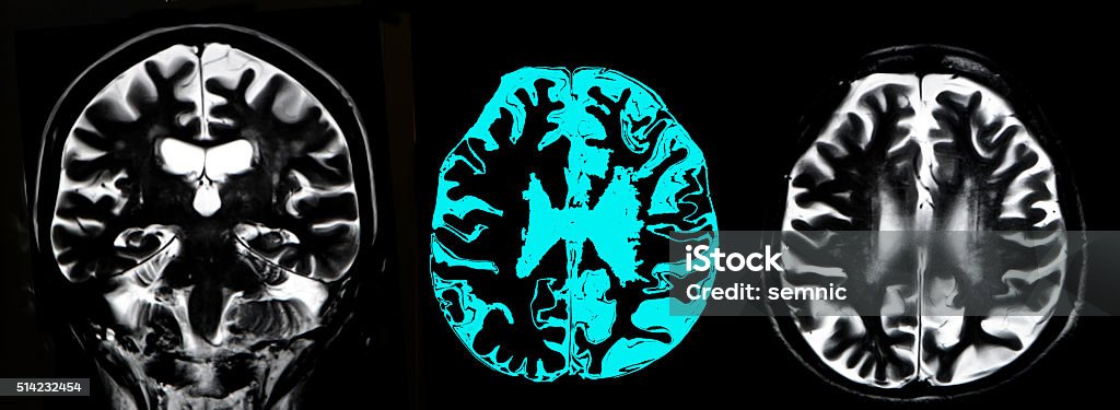 Brain Atrophy Mri Stock Photo Download Image Now Alzheimer S Brain Atrophy Mri Stock Photo Download Image Now Alzheimer S