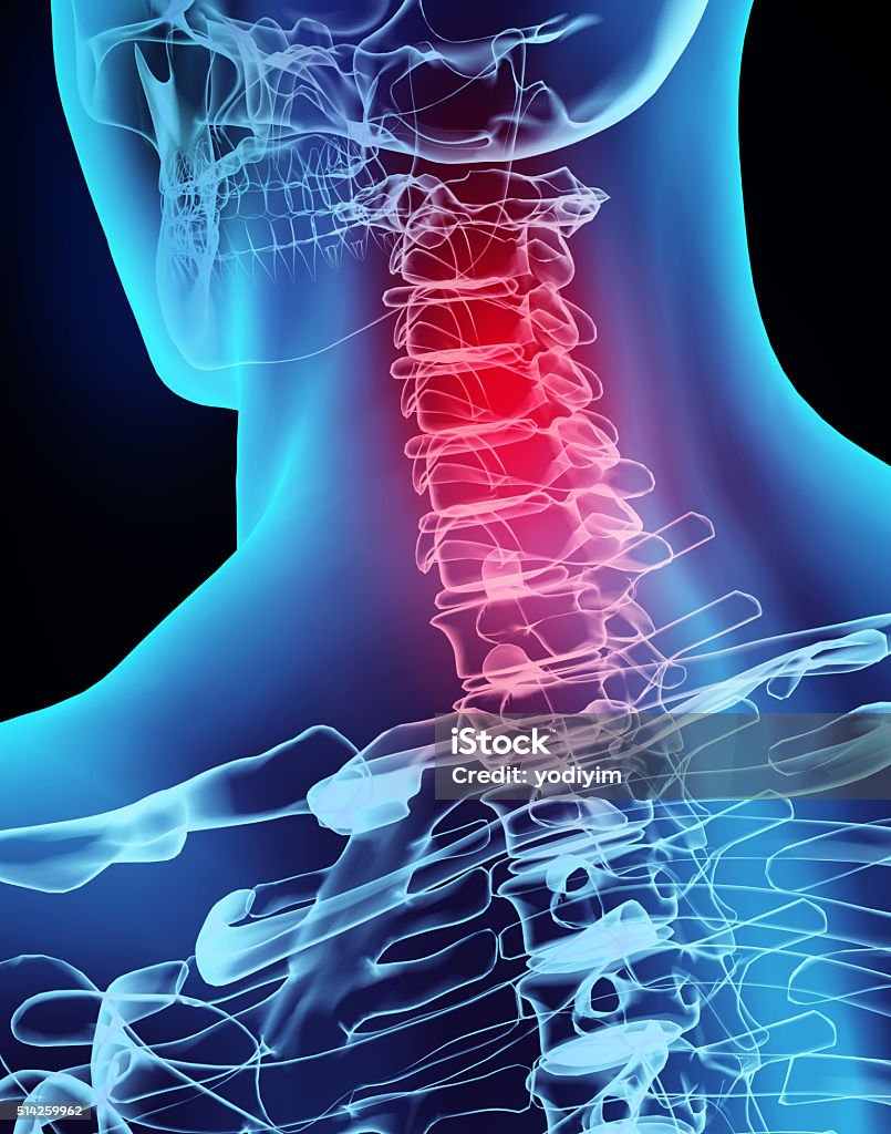 3 D ilustración de rayos x, dolor de cuello. - Foto de stock de Lesión de latigazo cervical libre de derechos