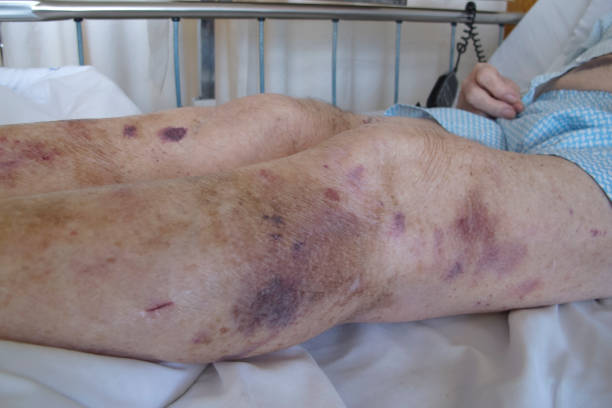 Senior man in hospital showing bruised legs