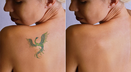 Laser tattoo removal befor and after. Beautiful young woman with tattoo on her back