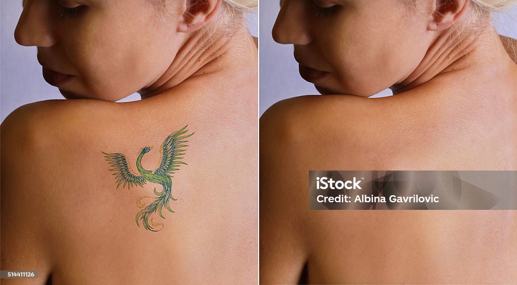Laser tattoo removal befor and after. Laser tattoo removal befor and after. Beautiful young woman with tattoo on her back Tattoo Stock Photo