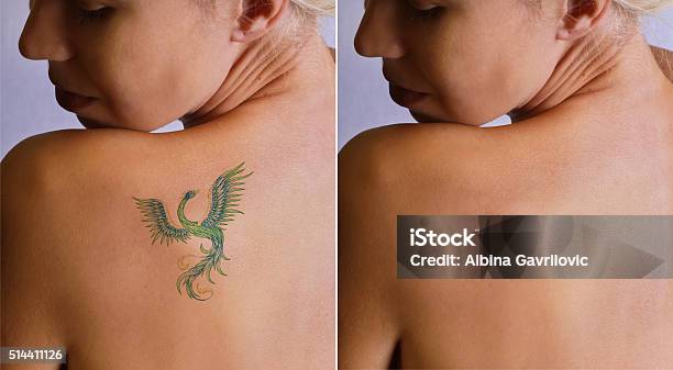 Laser Tattoo Removal Befor And After Stock Photo - Download Image Now - Tattoo, Removing, Medical Laser