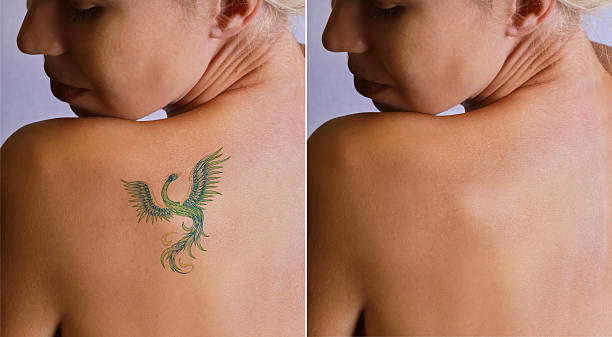 tatuagem remoção anterior à laser e depois. - tattoo women back rear view - fotografias e filmes do acervo