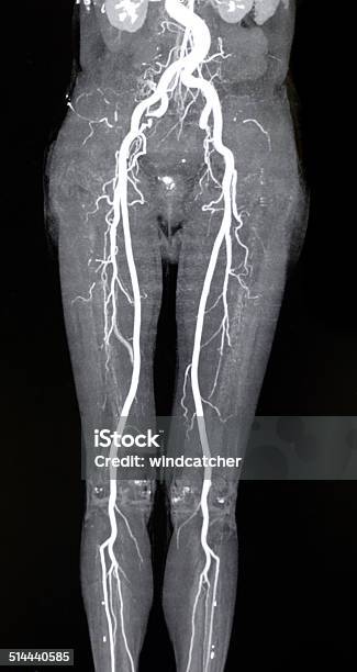 Lower Limbs Artery Mra Stock Photo - Download Image Now - MRI Scan, Femoral Artery, Inside Of