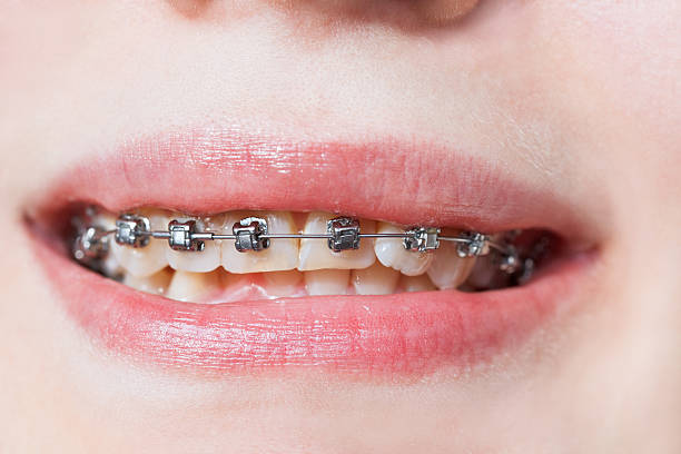 istock front view of dental braces on teeth of upper jaw 514930659