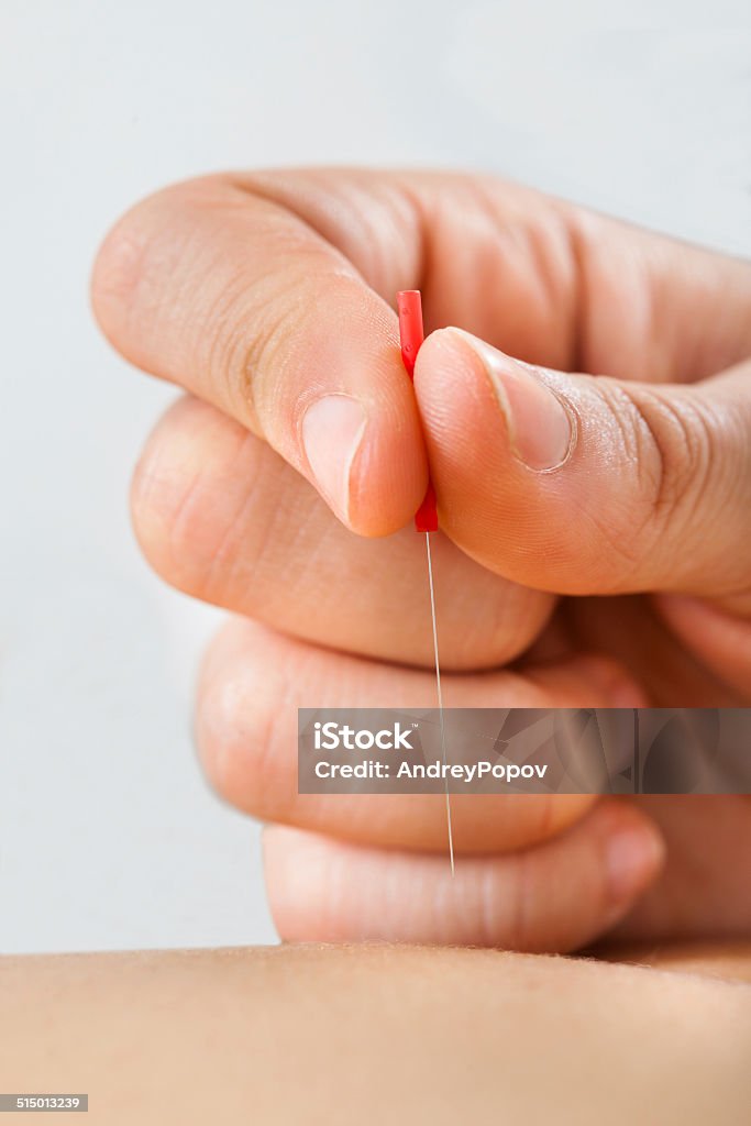 Therapist Giving Acupuncture Treatment To Woman In Spa Closeup of therapist giving acupuncture treatment to woman in spa Acupuncture Stock Photo