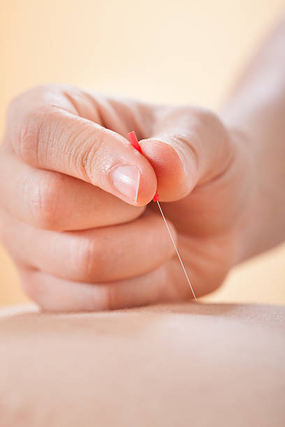 istock Acupuncturist Placing Needle On Man's Back In Spa 515013703