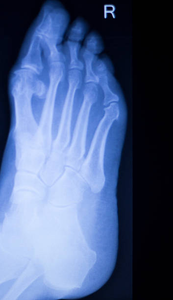 istock Foot and toes injury xray scan 515378930