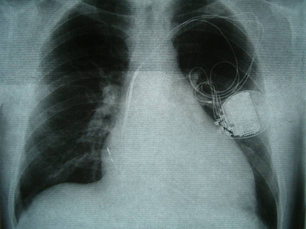 radiograph, brust, herz herzschrittmacher - human heart heart attack x ray image chest stock-fotos und bilder