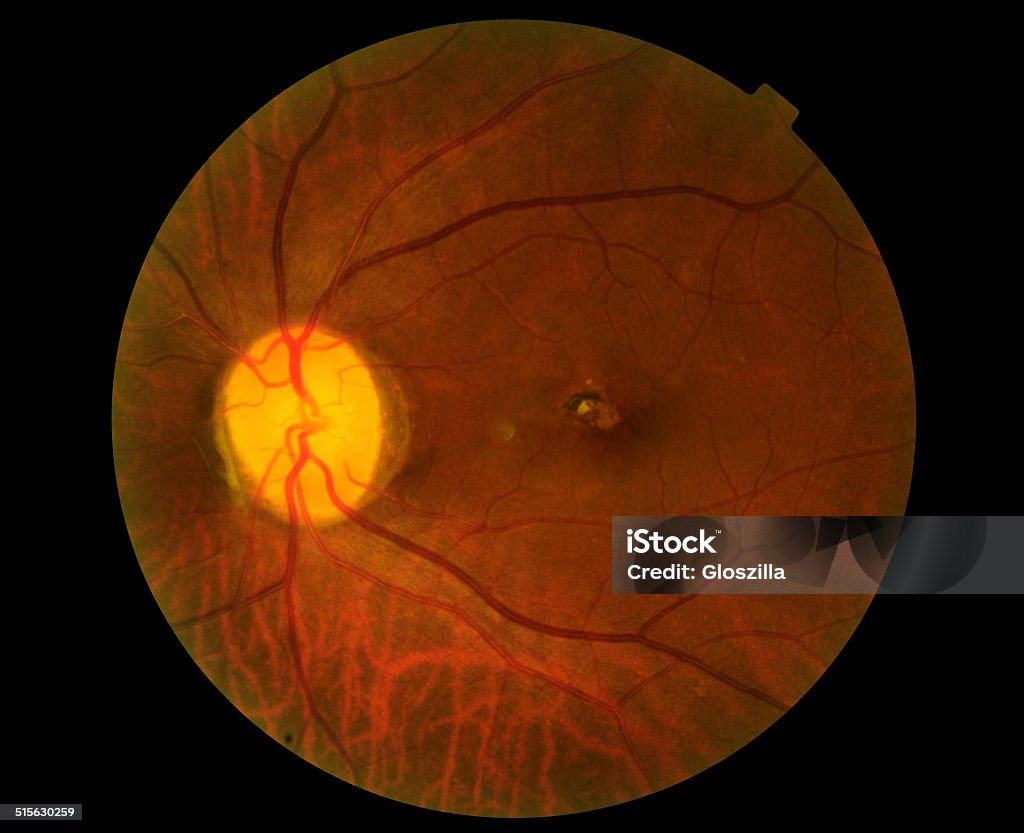 View inside human eye disorders View inside human eye disorders - showing retina, optic nerve and macula . Glaucoma Stock Photo